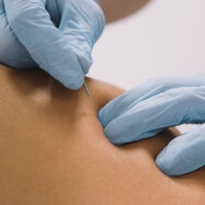 Ultrasound-Guided-Dry-Needling.jpg