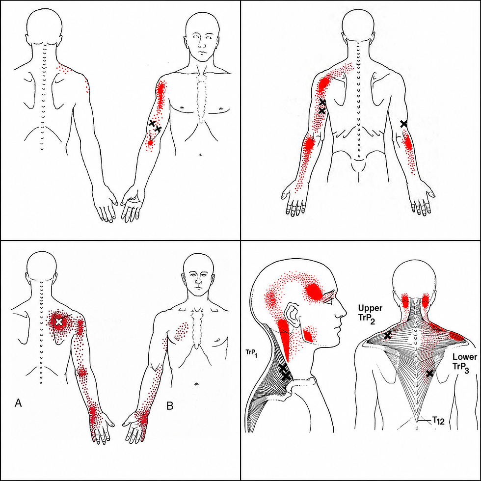 Trigger point referral pain diagrams showing shoulder, neck, and arm pain patterns treated with dry needling at Southeast PT.