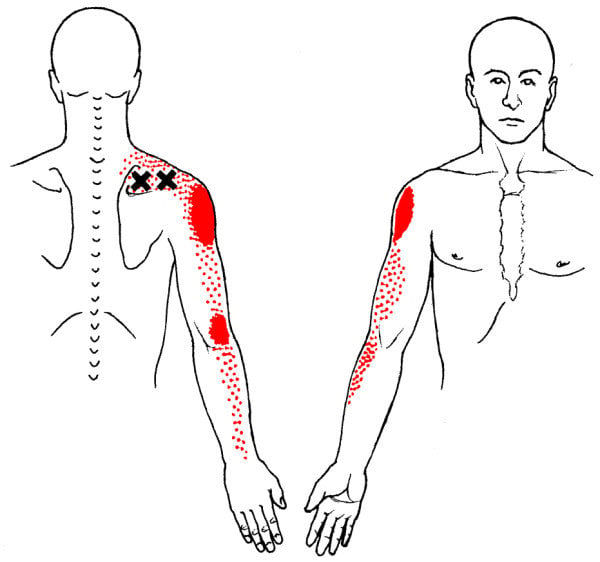 Supraspinatus trigger point referral pattern showing shoulder and lateral arm pain treated with dry needling at Southeast PT in Roswell, GA.