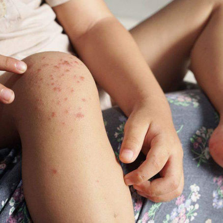 Hand-voet-en-mondsiekte is by 'n Bloemfonteinse kleuterskool aangemeld