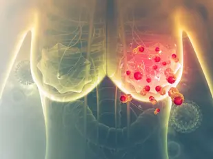 KI kan glo vroeë tekens van borskanker jare voor ‘n diagnose identifiseer