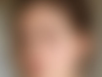 ¿Por qué me salen granos en la cara? Causas y cómo eliminarlos rápido