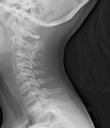 Rayos X de Cuello Lateral (para partes blandas) | UniRad