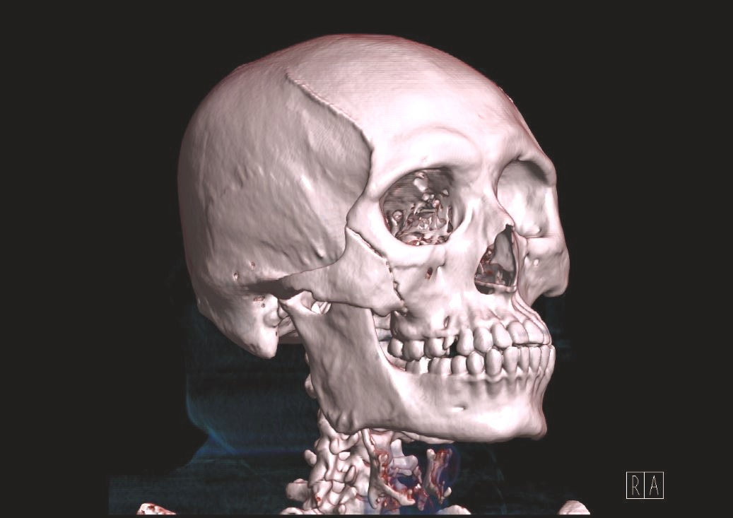 Tomografía (Tac) Tomografía Axial Computarizada de Senos Paranasales Fase Simple o Contrastada