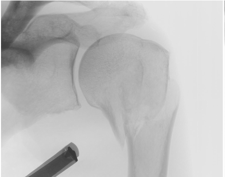 Shoulder_Prox. Humerus_Nailing_Xray2.png