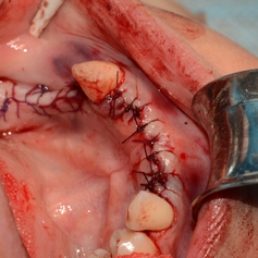 implants9-1024x678.png