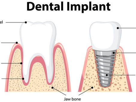 Signs of Dental Implant Failure and Treatment in Ahmedabad