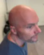 Före behandling