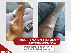 A fÃstula arteriovenosa pode formar um aneurisma?