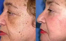 IPL treatment 2.webp