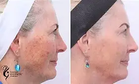 IPL treatment 1.webp