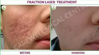 Fractional CO2 Laser 2.webp