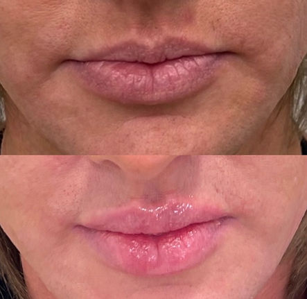 Lip filler 3b.JPG