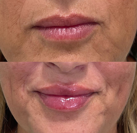 Lip filler 2a.JPG