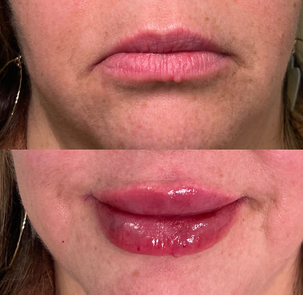 Lip filler 4c.JPG