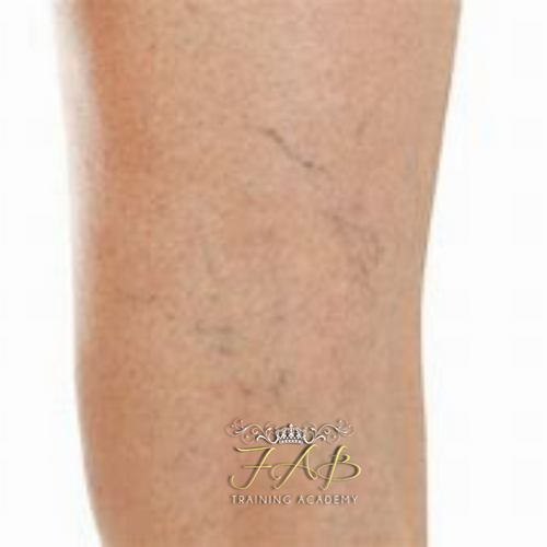 Sclerotherapy Flawless Aesthetics