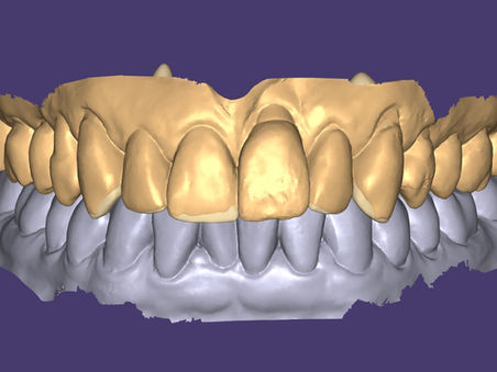 Palatal Veneer
