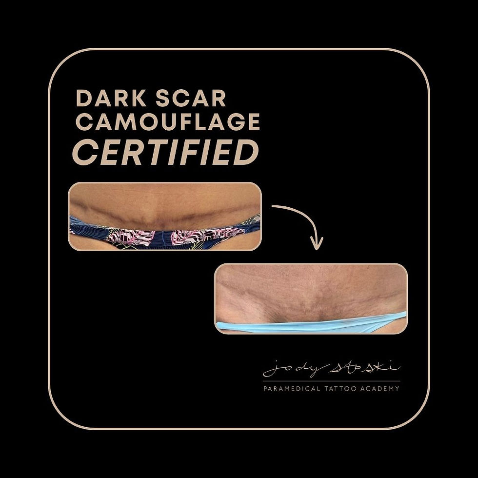 Tummy Tuck Scar Camouflage Maynard MA