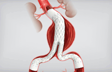 tecnica_cirurgica_endovascular.gif