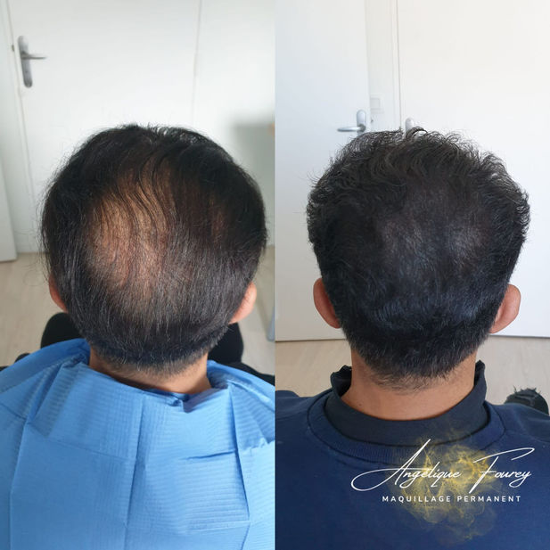 Avant-après dermopigmentation capillaire à Caen