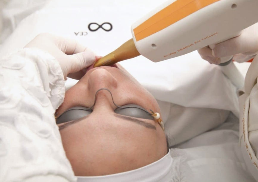 Laser Fracionado Intraoral.jpeg