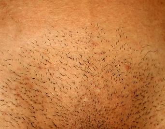 Depilacion laser. Consultori Azon-Torrees