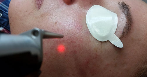 laser facial. Consultori Azon-Torres