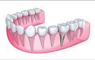Implants 1.jpeg