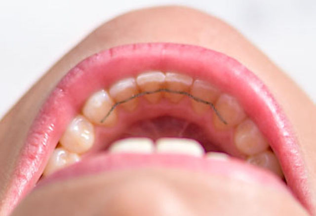 Photo d'un traitement d'orthodontie fixe 