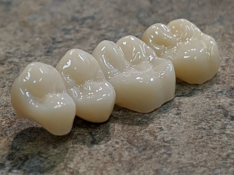 A Ceramic high-tech dental crown. Tooth crown covers the tooth for strength and esthetics. Fix broken tooth, badly damaged tooth, and discoloured tooth. Ceramic crown, zirconia crown, emax crown. Tooth crowns are strong and durable.
