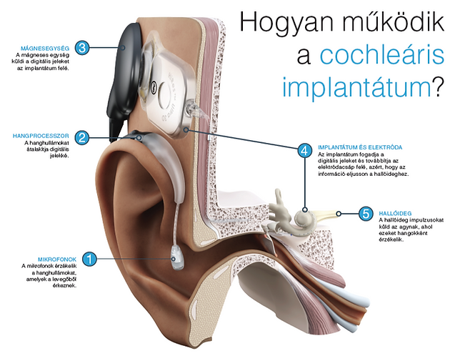 AB-cochleáris-implantátum.PNG