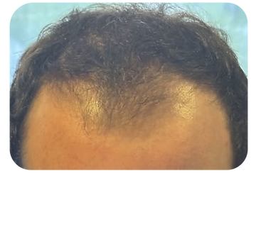 antes pelo 1.png