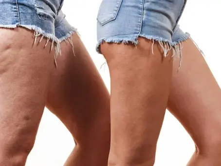 Combien de séances de massage minceur faut-il et à quelle fréquence pour des résultats visibles ?