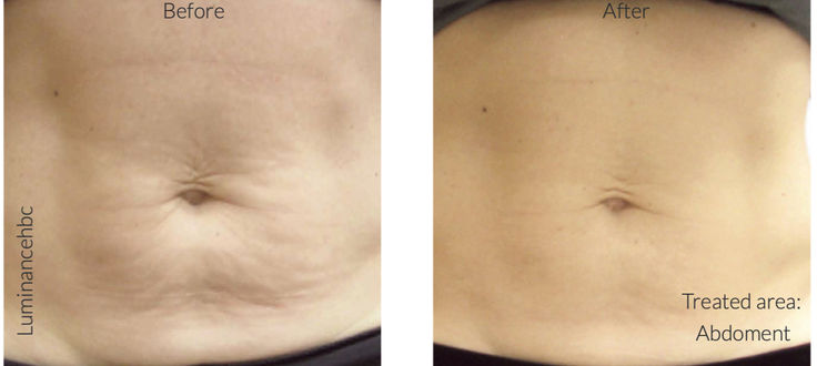 Venus Freeze® Body Contouring using Radio Frequency and Magnetic Pulse in Missouri City, Sugar Land & Houston, TX