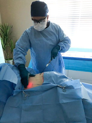 Smart Lipo - Performed by Dr. Chinh Pham