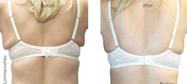 Venus Freeze® Body Shaping
in Missouri City, Sugar Land & Houston, TX