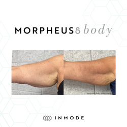 Spa Face_Body_Morpheus8 Body_Before_After