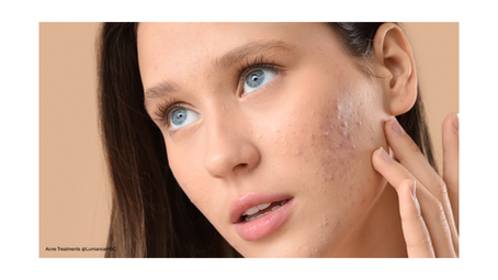 Adult Acne in Sugar Land: Causes, Triggers, and Medical-Grade Solutions