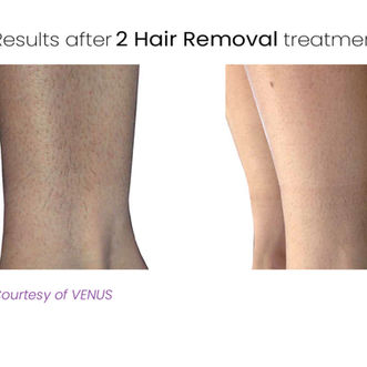 Laser Hair Removal
in Missouri City, Sugar Land & Houston, TX