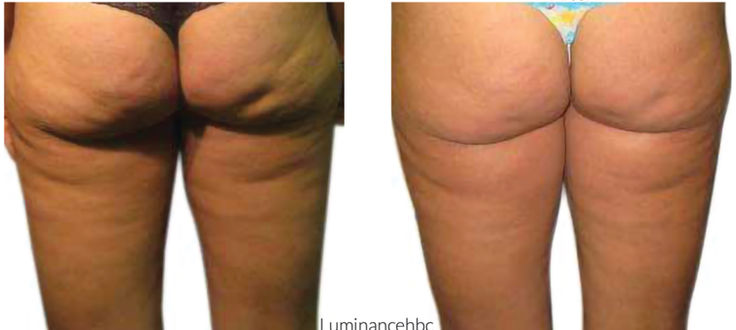 Venus Freeze® Body Shaping
in Missouri City, Sugar Land & Houston, TX