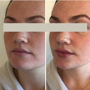 before and after lip filler