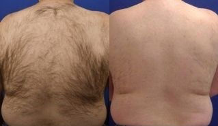 ba hair removal.jpg