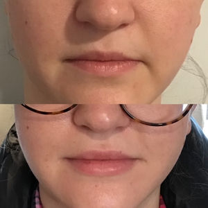 before and after lip filler