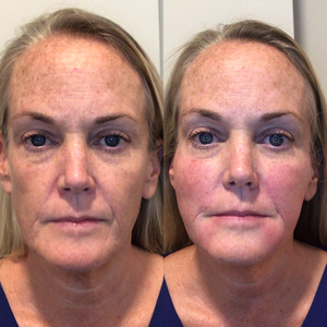 before and after facial rejuvenation