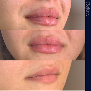 before and after lip filler