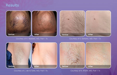 hair-removal-email-results-600x385.jpg