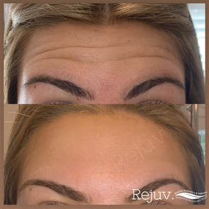 before and after botox forehead lines 6.PNG