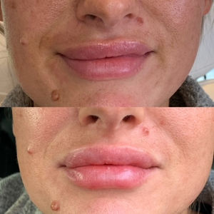 before and after lip filler