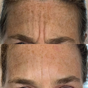 before and after botox forehead lines.jpg