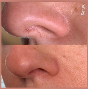 before and after laser vein treatment_edited.jpg